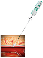 Angio-Seal collagen plug deployed