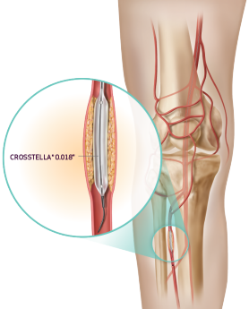CROSSTELLA® 0.014”