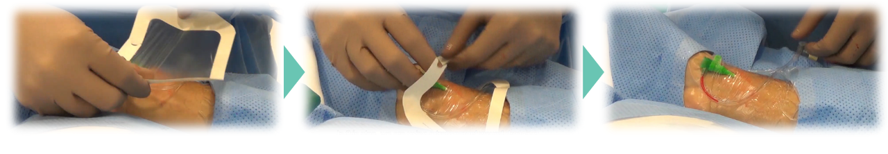 Pictures of application of transparent surgical dressing tape over product