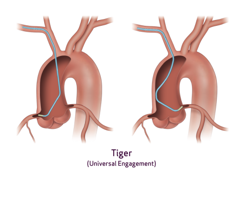 Illustration of Tiger (Universal Engagement) OPTITORQUE placement