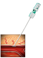 Angio-Seal anchor deployed in an artery