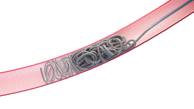 Image of Hydropack coil in a vessel