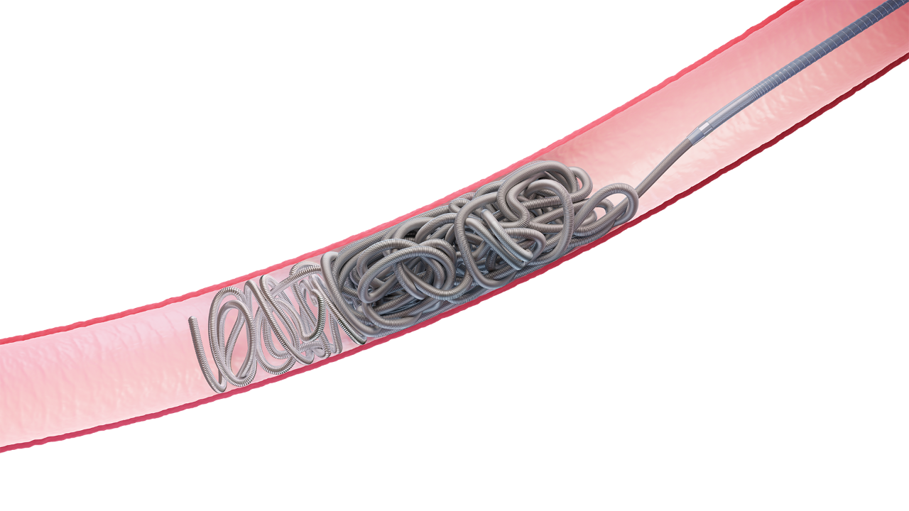 Image of Hydropack coil in a vessel